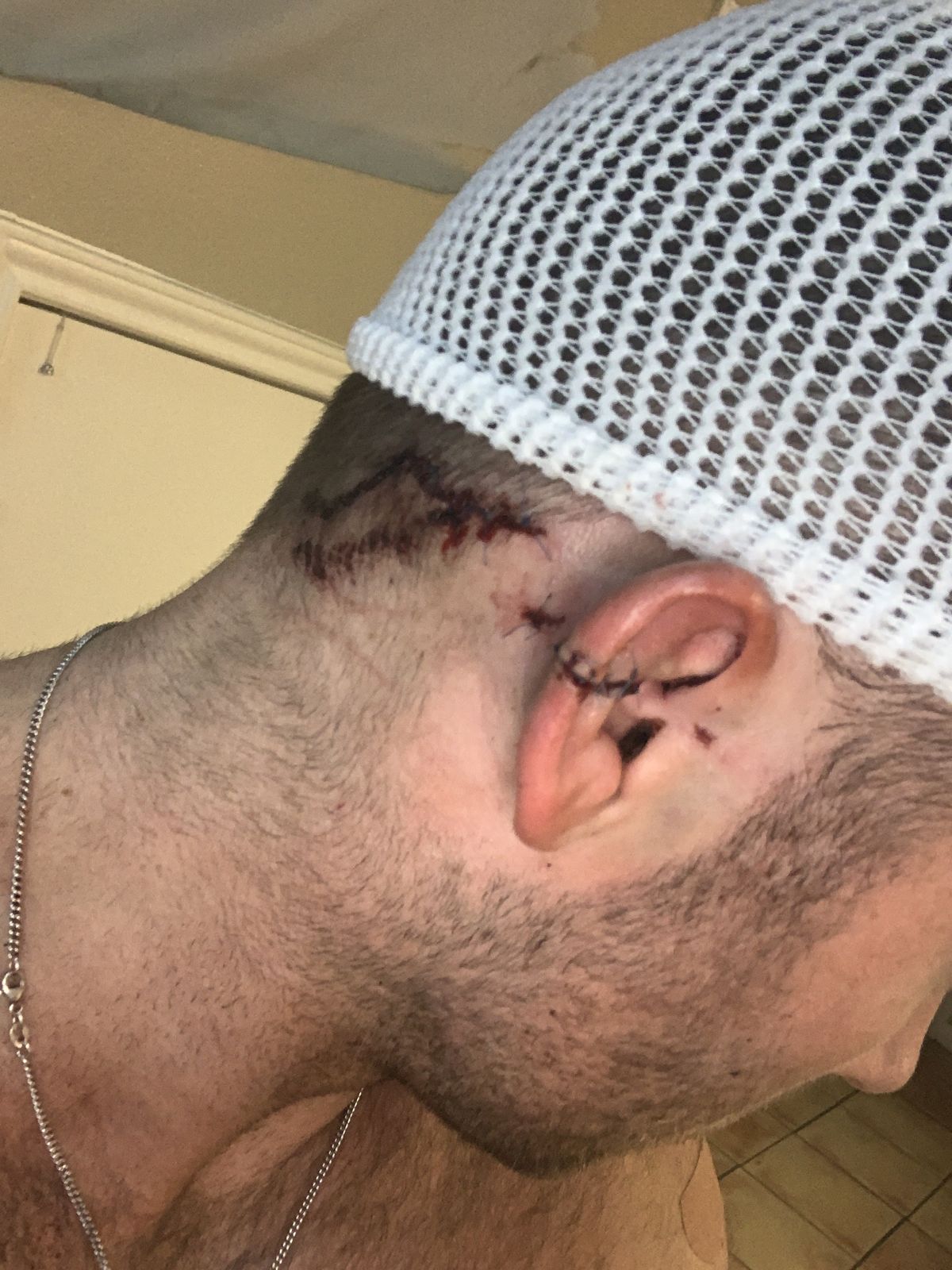 Stitches on Matt's head and ear after the 2020 stabbing